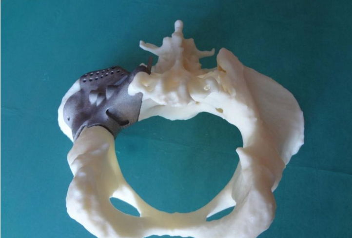 骨组织3D打印技术打印，成为骨再生的未来希望